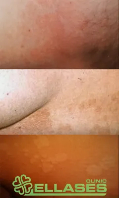 Конец по Versicolor/Pityriasis Versicolor опоясывающему лишаю кожного  заболевания Стоковое Фото - изображение насчитывающей воспаление, агенства:  197614758