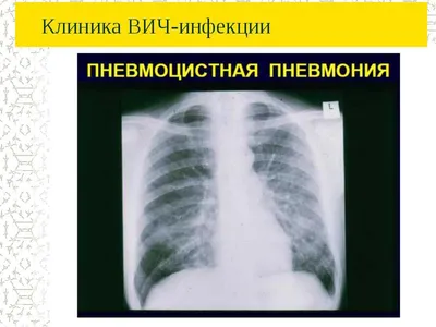 Вирус герпеса -3 (продолжение) – Опоясывающий лишай – Propid