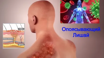 Опоясывающий герпес — Derma.ua