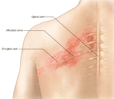 Лечение и уход за опоясывающим лишаем