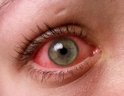 Желтые пятна на белке глаза: причины, диагностика и лечение в ГКДБ