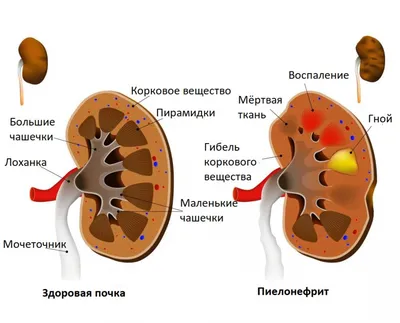 Почему воспаляются лимфоузлы в паху?