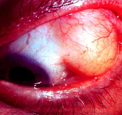 Опухоли глаза: виды и лечение - Área Oftalmológica Avanzada