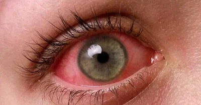 Онкология глаза или как я лечил опухоль (меланому) брахитерапией (часть 5:  радиоблучение глаза) | Ян Янин: PRO жизнь | Дзен