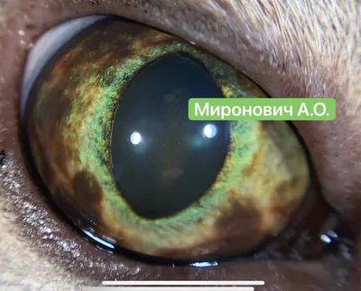 Брахитерапия опухоли глаза – Prof. Merdan Fayda