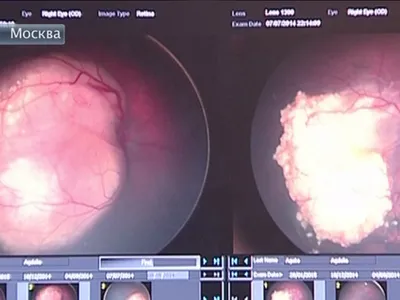 Рак глаза - презентация онлайн