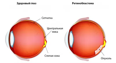 Симптомы и лечение рака глаза | Онкология — не приговор | Дзен