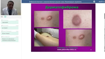 Болезненная опухоль — Курсы по дерматоскопии | Юрий Сергеев