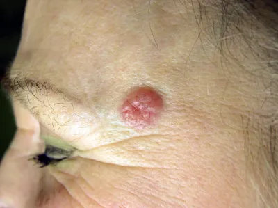 Родимое пятно, Papilloma или доброкачественная опухоль на коже конца-вверх  молодой женщины Стоковое Фото - изображение насчитывающей женщина, бобра:  124061582