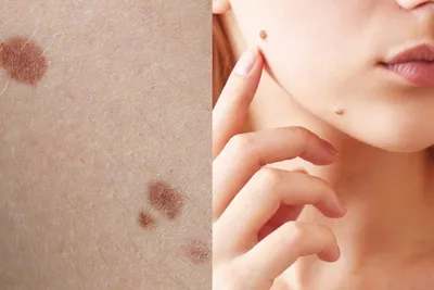 В течение 3.5 лет женщина отмечала рост пигментного образования на коже  плеча, в октябре этого года обратилась в частную клинику. Там… | Instagram