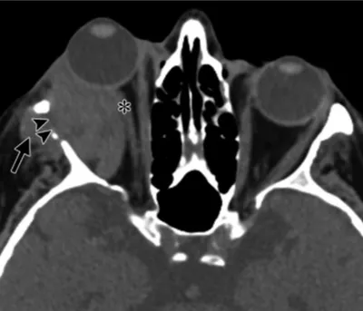 Опухоли орбиты у взрослых: клинический, радиологический и...