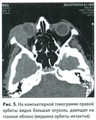 PDF) ORBITAL METASTASES OF SOLID TUMORS. DIAGNOSTIC PROBLEMS