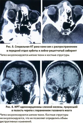 Офтальмоонкология – зона особого внимания