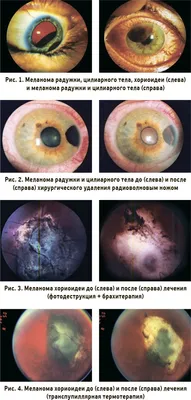 Офтальмоонкология – зона особого внимания