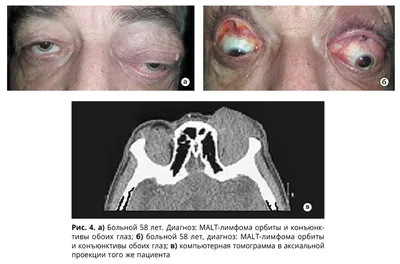 Особенности клинической картины неходжкинских лимфом придаточного аппарата  глаза - Страница 2 из 2 - Издательство АПРЕЛЬ