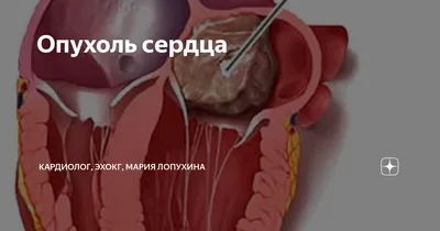 Опухоли сердца у детей — редкая врожденная патология сердечно-сосудистой  системы. (Часть I) | Інтернет-видання \"Новини медицини та фармації\"