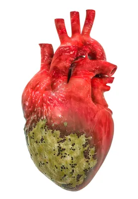 Опухоли, связанные с сердцем