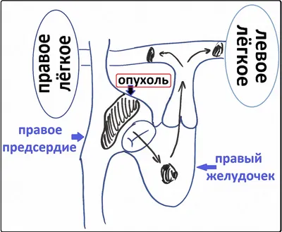 Учёные назвали причины рака сердца