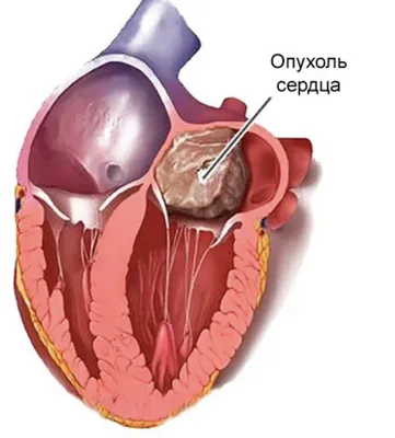 Опухоль сердца | Кардиолог, ЭХОКГ, Мария Лопухина | Дзен