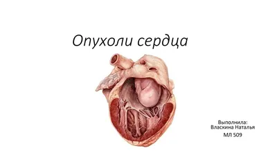 Опухоль сердца?