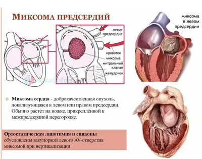 Опухоль сердца | Кардиолог, ЭХОКГ, Мария Лопухина | Дзен