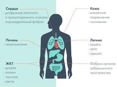 Ангиосаркома — вид первичных злокачественных опухолей сердца из группы  сарком, которые развиваются из клеток кровеносных и лимфатических… |  Instagram