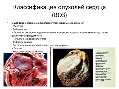 Рак легких: признаки, симптомы, стадии, лечение