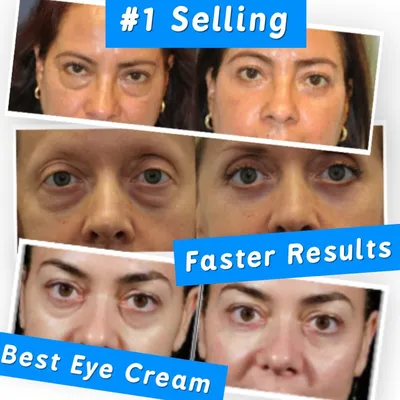 Крупный план опухшего глаза женщины, вызывающего мешки под глазами на белом  фоне | Премиум Фото