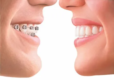 Характеристики и преимущества лингвальной ортодонтии | Clínica Dental  Moreno-Montalvo