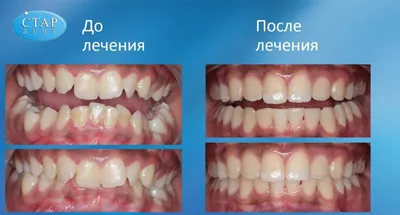 Ортодонтия для взрослых и детей | Стоматология 24 часа на Семеновской