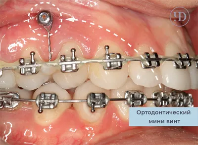 Технические нюансы ортодонтического лечения: MARPE - интересно об ортодонтии,  имплантации и протезировании зубов