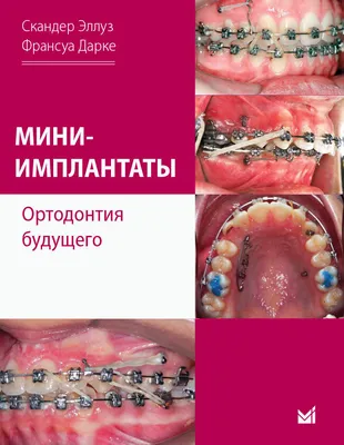 Ортодонтия. Брекеты для детей и взрослых в Одессе. - Hellas Dental