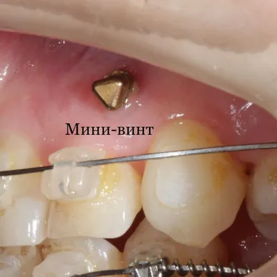 Мини-имплантаты. Ортодонтия будущего - купить с доставкой по выгодным ценам  в интернет-магазине OZON (306538954)
