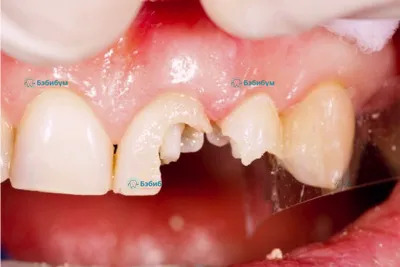 Восстановление зуба на штифте в стоматологии Бэбибум в Оренбурге