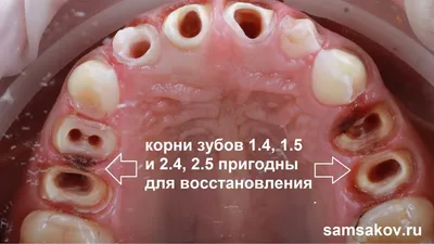 Как восстановить зуб если остался только один корень | Альянс  бьюти-ортопедов, Москва