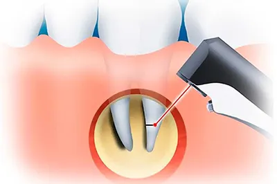 Удаление корня зуба: особенности операции и возможные осложнения -  Стоматология ЭспаДент