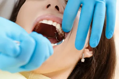 Удаление корня зуба - DentaKlad