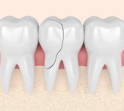 Что делать если откололся кусочек зуба?