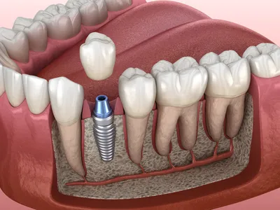 Остался только корень зуба – удалить или восстановить? | Центр имплантации  Доктора Федорова | Дзен