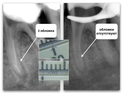 Сломанный инструмент в зубном канале после лечения...?