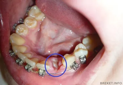 Материалы с меткой \"зуб в десне\" | Брекет.Info