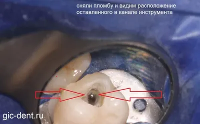 Спасаем зуб от забытого в зубном канале инструмента - Немецкий  имплантологический центр