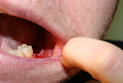Последствия и осложнения после удаления зубов | Надент