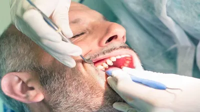 Осколок зуба после удаления: какие симптомы и последствия, удаление осколка