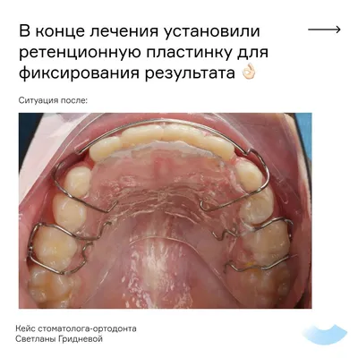 Как Вырвать Зуб Без Боли Дома Ниткой ЛюмиДент