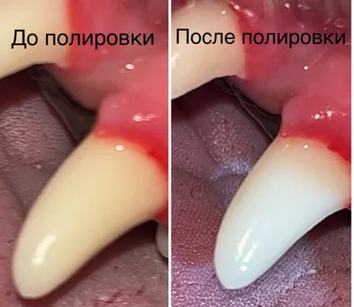 Что делать если сломался зуб? Передний зуб или сломался под корень