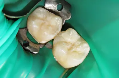 Сломался зуб - что делать, если сломался зуб: восстановление скола