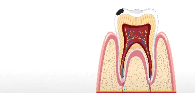 Кариес зубов - причины, симптомы, диагностика, лечение | Профилактика  кариеса