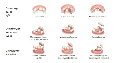 Лечение кариеса зубов недорого в Москве - стоматология Самсон-Дента