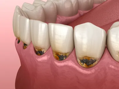Стадии кариозной инфекции зубов - выявление и лечение